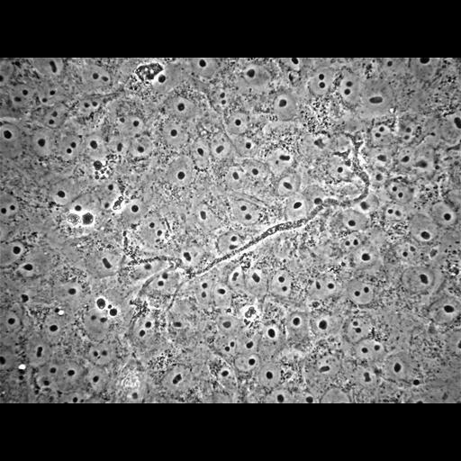  NCBI Organism:Balamuthia mandrillaris; Cell Types:cell by organism, eukaryotic cell, , ; Cell Components:cell, pseudopodium; Biological process:pseudopodium organization, pseudopodium assembly, pseudopodium retraction;