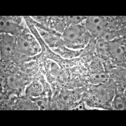  NCBI Organism:Balamuthia mandrillaris; Cell Types:cell by organism, eukaryotic cell, , ; Cell Components:cell, pseudopodium; Biological process:pseudopodium organization, pseudopodium assembly, pseudopodium retraction;