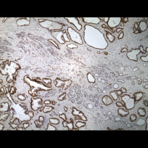  NCBI Organism:Homo sapiens; Cell Types:endocrine-paracrine cell of prostate gland, basal cell of prostate epithelium, luminal cell of prostate epithelium, blood vessel endothelial cell, perineural cell, sheath cell, leukocyte, prostate stromal cell, smooth muscle cell of prostate; Cell Components:nucleus, cell surface;