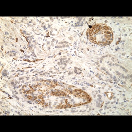  NCBI Organism:Homo sapiens; Cell Types:endocrine-paracrine cell of prostate gland, basal cell of prostate epithelium, luminal cell of prostate epithelium, blood vessel endothelial cell, perineural cell, sheath cell, leukocyte, prostate stromal cell, smooth muscle cell of prostate; Cell Components:nucleus, cell surface;