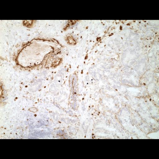  NCBI Organism:Homo sapiens; Cell Types:endocrine-paracrine cell of prostate gland, basal cell of prostate epithelium, luminal cell of prostate epithelium, blood vessel endothelial cell, perineural cell, sheath cell, leukocyte, prostate stromal cell, smooth muscle cell of prostate; Cell Components:nucleus, cell surface;