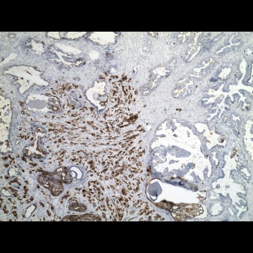  NCBI Organism:Homo sapiens; Cell Types:endocrine-paracrine cell of prostate gland, basal cell of prostate epithelium, luminal cell of prostate epithelium, blood vessel endothelial cell, perineural cell, sheath cell, leukocyte, prostate stromal cell, smooth muscle cell of prostate; Cell Components:nucleus, cell surface;