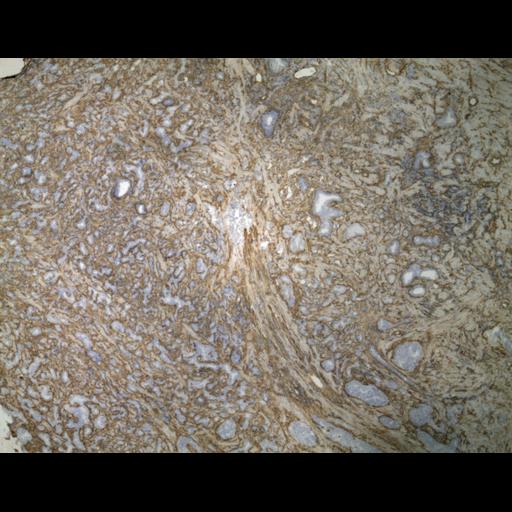  NCBI Organism:Homo sapiens; Cell Types:endocrine-paracrine cell of prostate gland, basal cell of prostate epithelium, luminal cell of prostate epithelium, blood vessel endothelial cell, perineural cell, sheath cell, leukocyte, prostate stromal cell, smooth muscle cell of prostate; Cell Components:nucleus, cell surface;