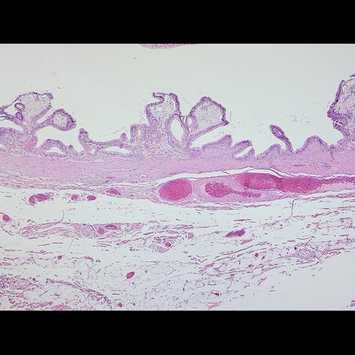  NCBI Organism:Homo sapiens; Cell Types:epithelial cell, foam cell; Cell Components:nucleus Biological process:leukocyte chemotaxis involved in inflammatory response, acute inflammatory response;