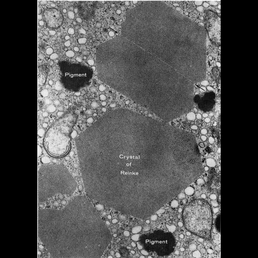  NCBI Organism:Homo sapiens; Cell Types:Sertoli cell Cell Components:inclusion body