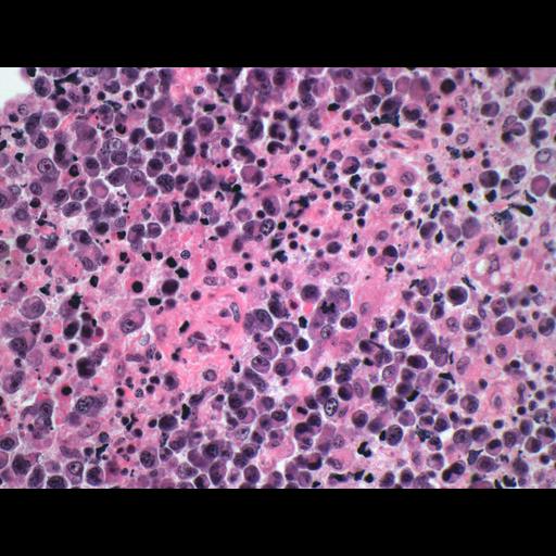  NCBI Organism:Homo sapiens; Cell Types:lymphocyte Biological process:immune response to tumor cell